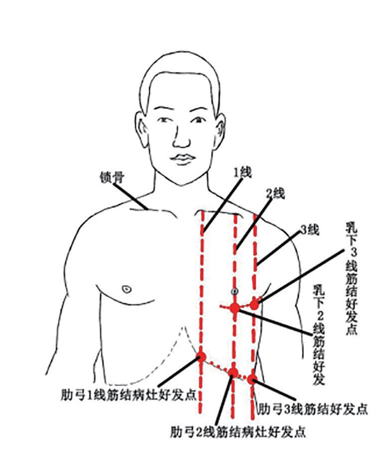 对胸部进行消灶解结时,要将"筋结"病灶按压于骨面上,确保治疗安全